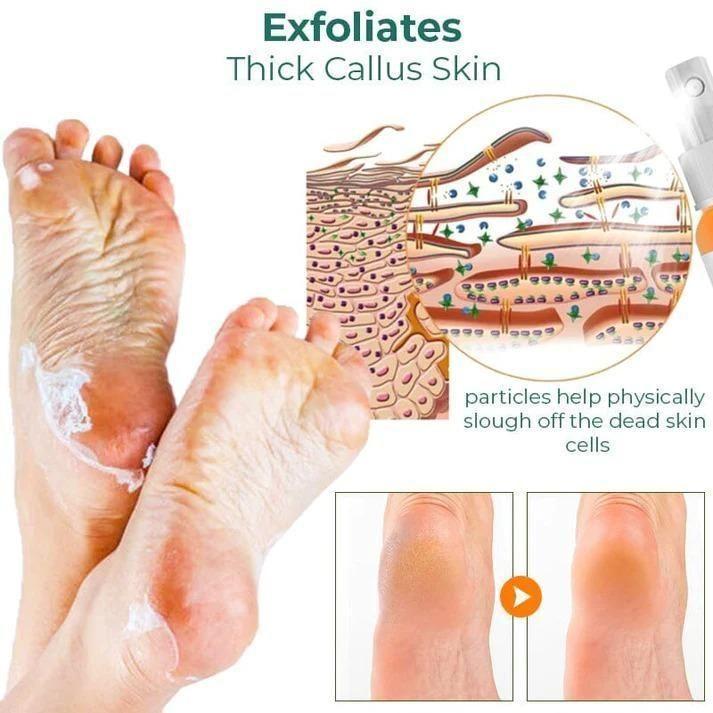 Foot Callus Removal Spray(Pack Of 2)